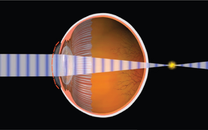 myopia és hyperopia fiziológia